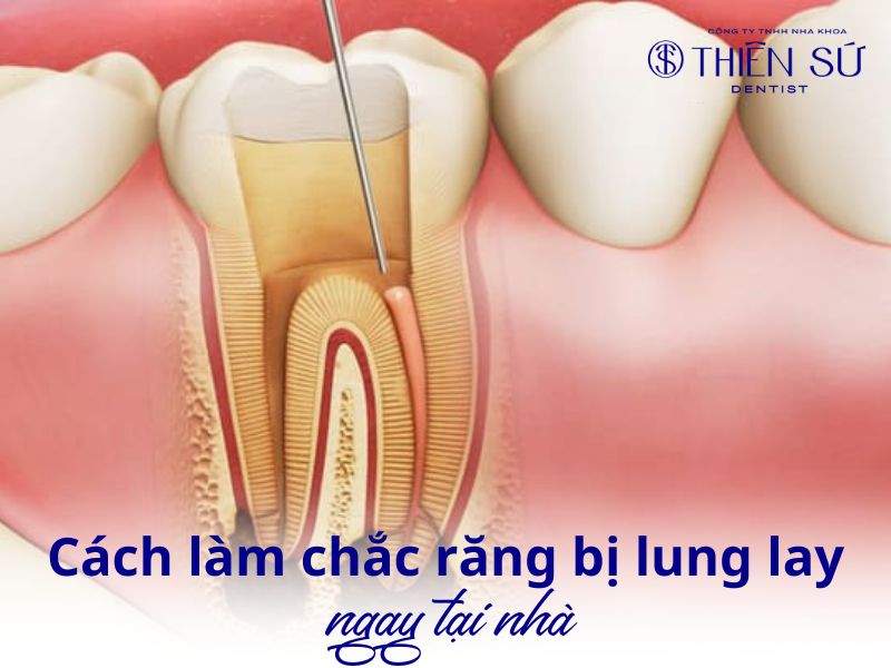 c&aacute;ch l&agrave;m chắc răng bị lung lay