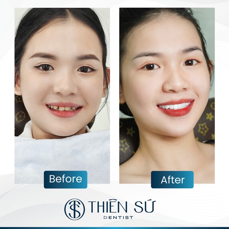 d&aacute;ng răng sứ đẹp
