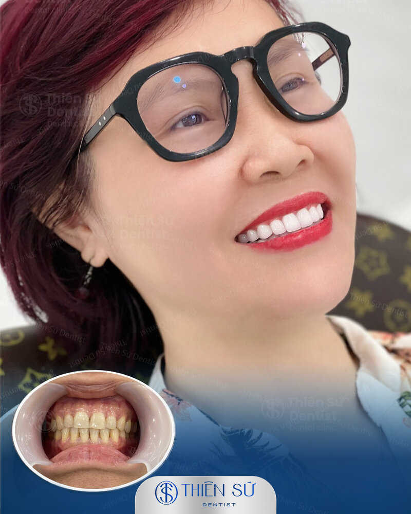 d&aacute;ng răng sứ đẹp