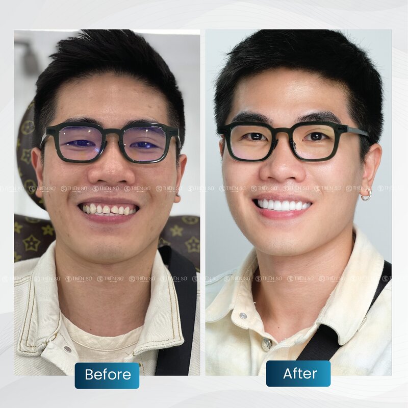 d&aacute;ng răng sứ đẹp