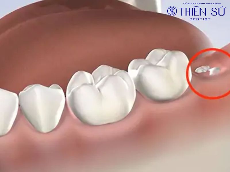 dấu hiệu mọc răng kh&ocirc;n