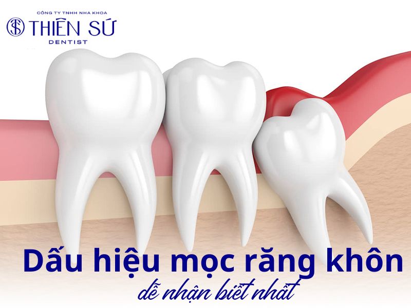 dấu hiệu mọc răng kh&ocirc;n