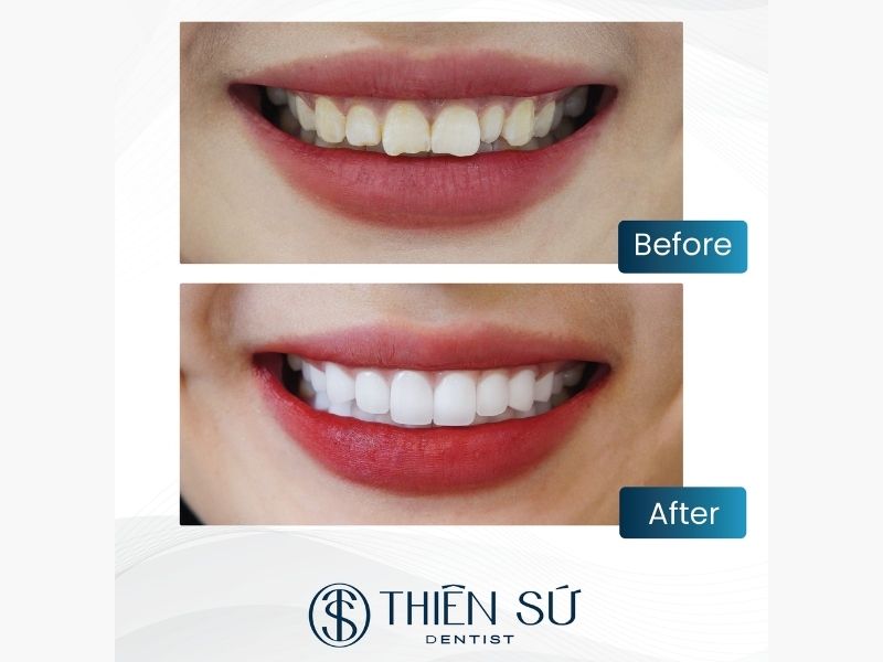 Những điều cần lưu &yacute; trước khi bọc răng sứ