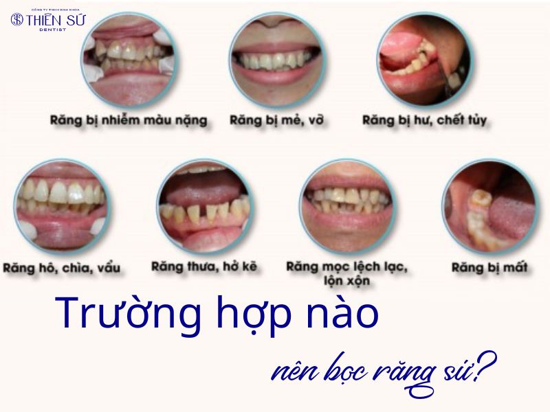 d&aacute;ng răng sứ đẹp