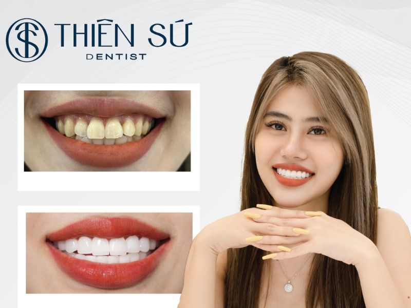 d&aacute;ng răng sứ đẹp