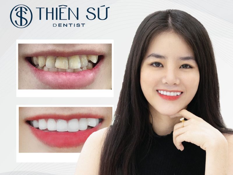 d&aacute;ng răng sứ đẹp