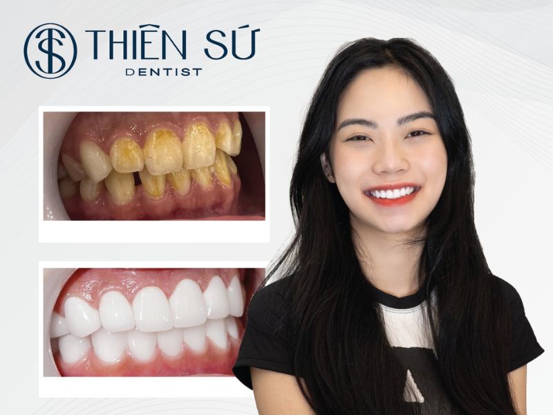 d&aacute;ng răng sứ đẹp