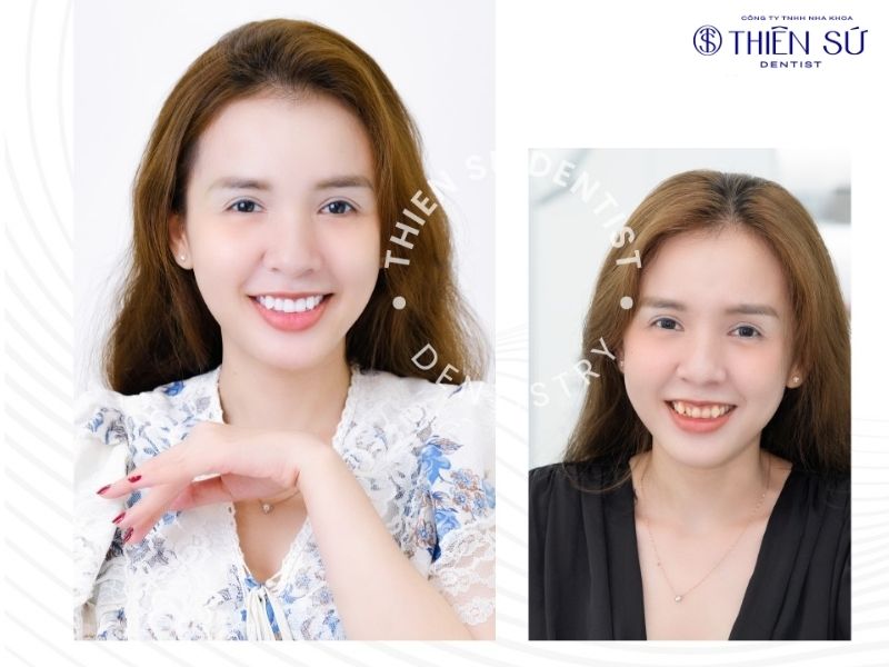 răng sứ sử dụng được bao l&acirc;u