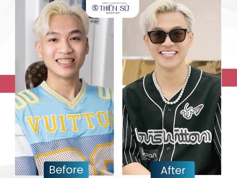 lắp răng tạm khi bọc sứ c&oacute; cần thiết kh&ocirc;ng